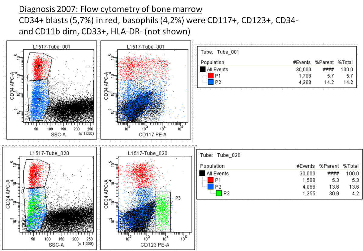 Fig 5. Bone marrow flow cytometry at diagnosis.